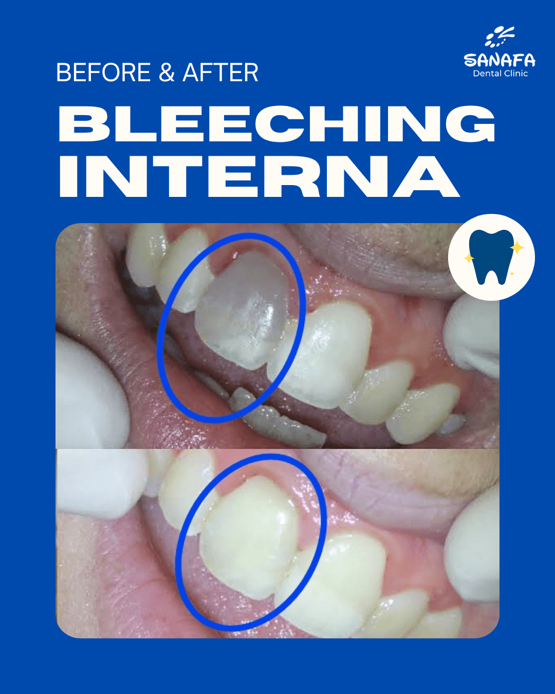 Poster dokumentasi before dan after perawatan Bleaching Interna Sanafa Dental Clinic