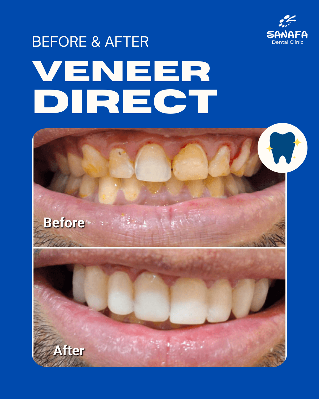Poster dokumentasi before dan after perawatan Veneer Direct Sanafa Dental Clinic