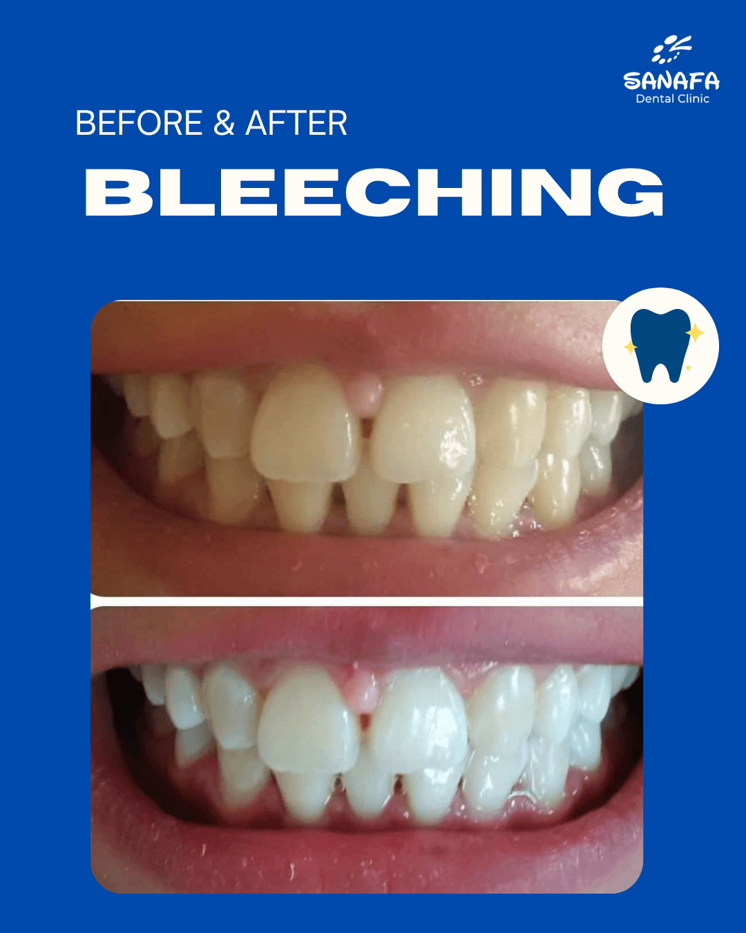 Poster dokumentasi before dan after perawatan Bleaching Sanafa Dental Clinic