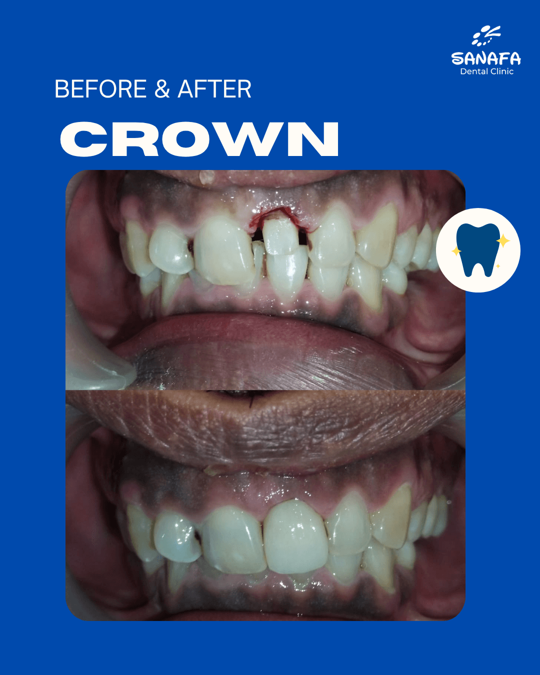 Poster dokumentasi before dan after perawatan Crown Sanafa Dental Clinic