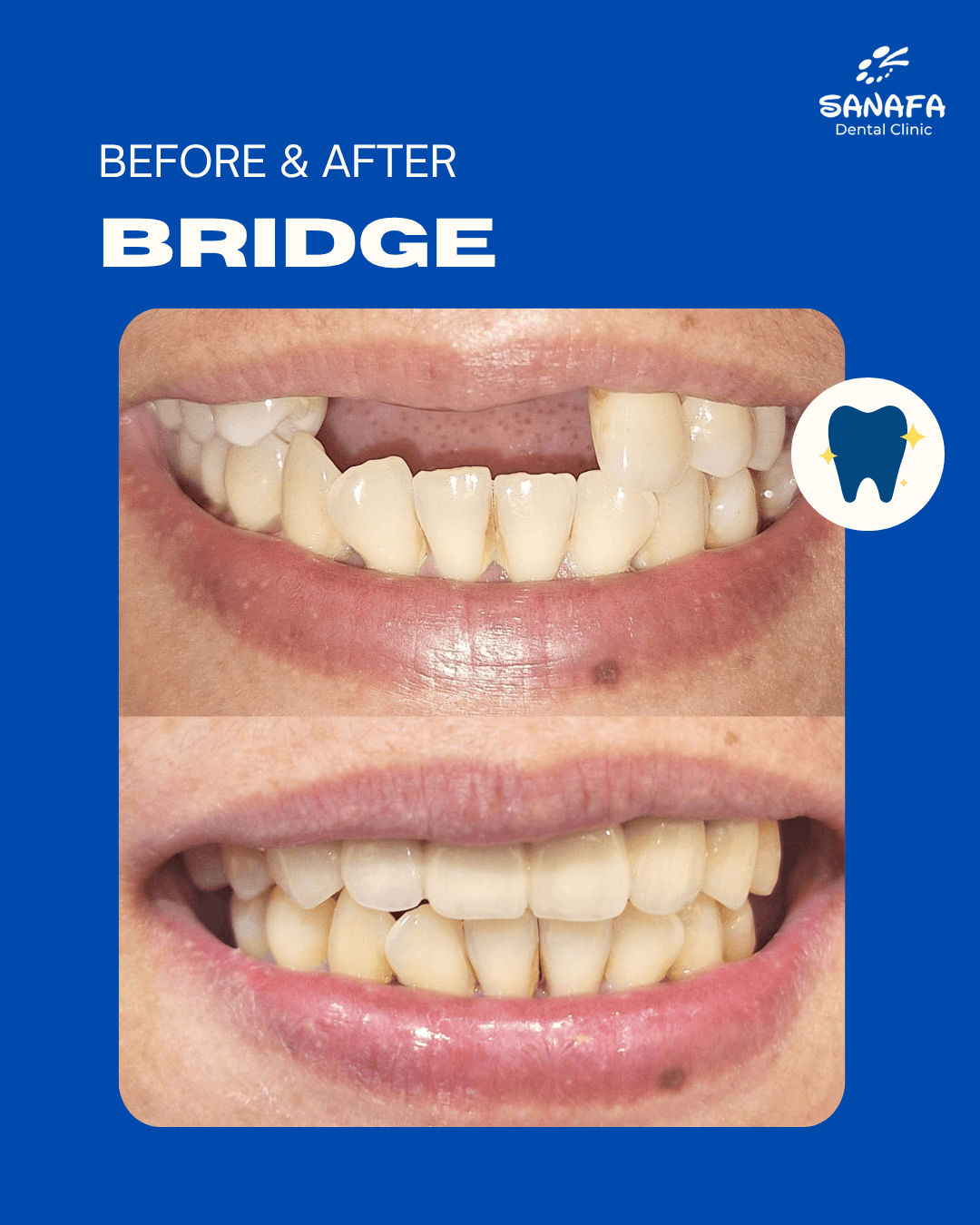 Poster dokumentasi before dan after perawatan Bridge Sanafa Dental Clinic