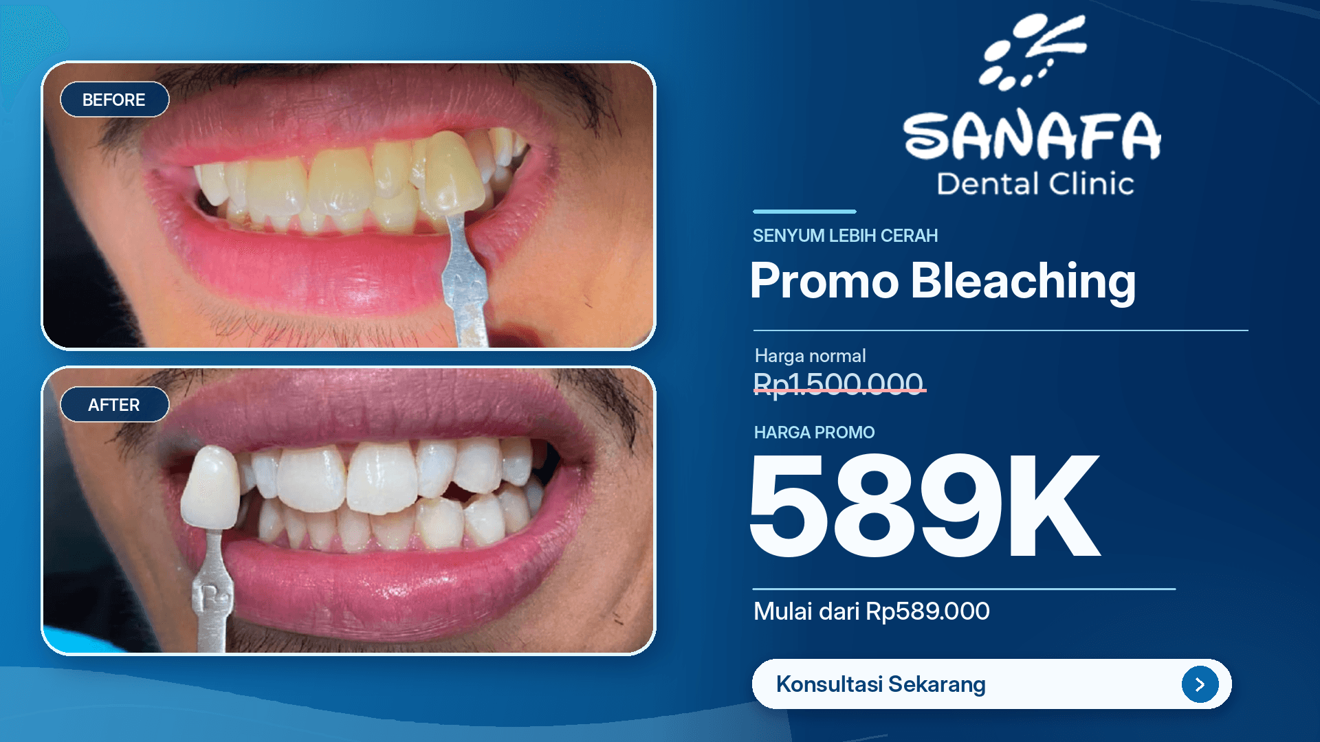 Promo Bleaching Sanafa Dental Clinic mulai Rp589.000, dengan foto sebelum dan sesudah perawatan.